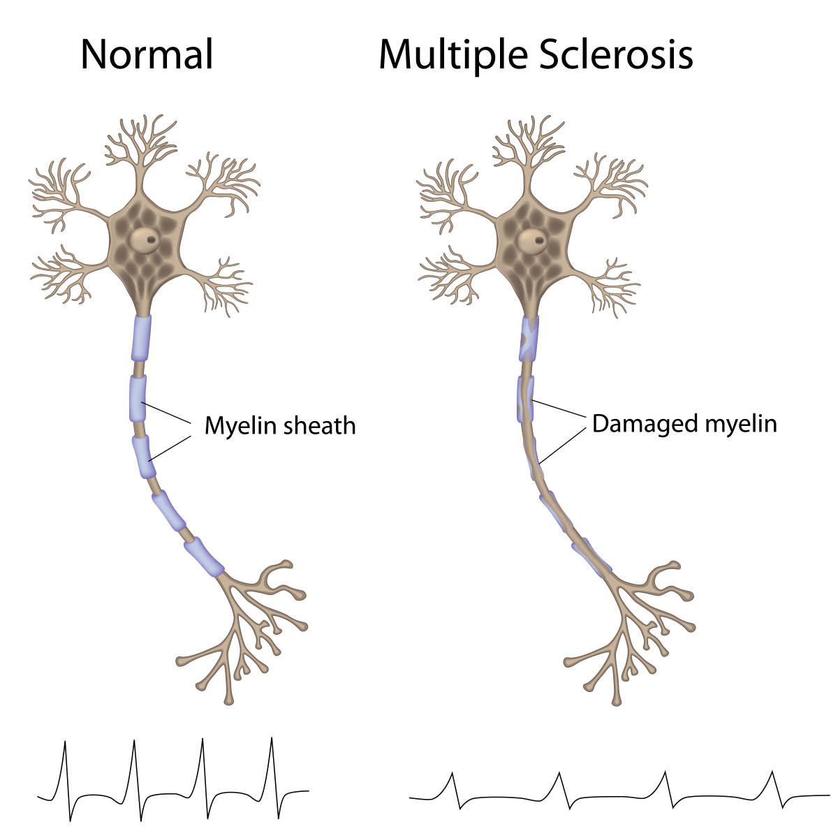 brain cell MS